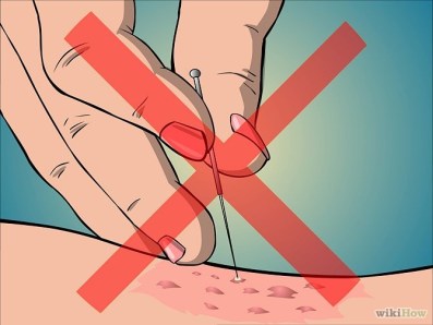 670px-Get-Rid-of-Acne-Cysts-Fast-Step-3-Version-2